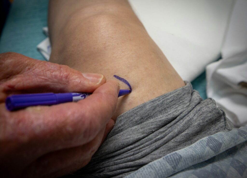 A person is marking a spot on the arm.